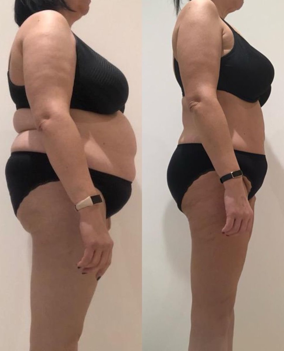 До и после Эндосфера-терапии - зона живота, боковой ракурс, курс в Body Bubbles Кишинёв
